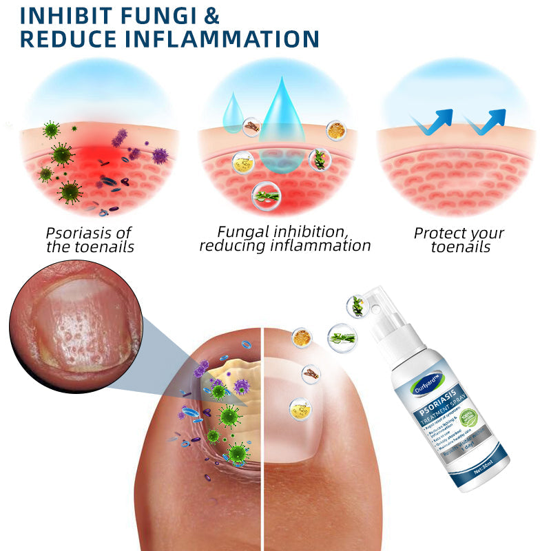 Ourlyard™ Psoriasis Treatment Spray